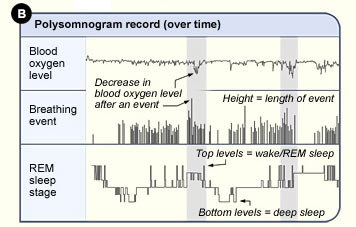 polysomnogram results