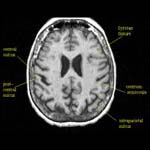 White Matter and Obstructive Sleep Apnea